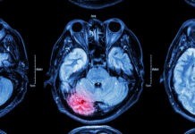 «Інсульт вимагає невідкладного медичного втручання»: Олександр Шиш директор департаменту охорони здоров’я Вінниці