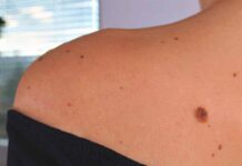 Вінницька лікарка дерматовенеролог розповіла про папіломи, чому з’являються і як їх позбутись