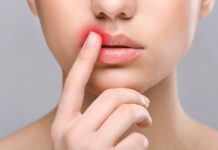 Герпес на губах, що провокує та як його вилікувати розповіла вінницька лікарка інфекціоніст