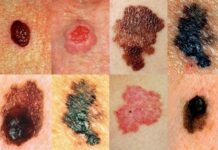 У Вінниці триває місяць обізнаності про меланому меланома