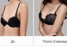 Вартість пластичних операцій грудей: фактори, що впливають на ціну Збільшення грудей