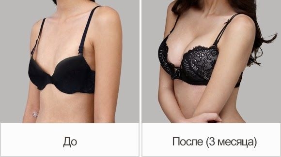 Збільшення грудей Збільшення грудей