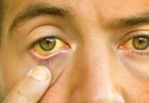 Інфекціоністи попередили про спалах гепатиту А у Вінниці