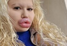 Фанатизм у пошуках ідеальної зовнішності: найбільші губи у світі