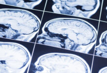 На Вінниччині 10 лікарень безкоштовно надають допомогу при гострому мозковому інсульті