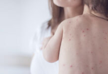 З початку року в Україні зафіксовано 23 випадки захворювання на кір