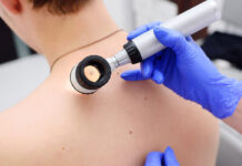 Вінничани зможуть безплатно перевірити свої родимки. Де і коли?