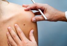 У Вінниці можна безкоштовно перевірити шкіру на наявність злоякісних новоутворень