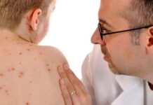 На Вінниччині спалах кору: 37 випадків з початку року