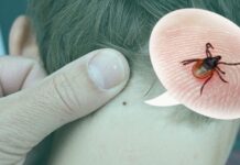 Вінниччина: кількість випадків бореліозу у травні зросла майже удвічі