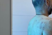 Центр інфекційних хвороб надає нову послугу фототерапії при псоріазі, вітиліго, екземі