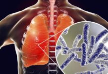 За сім місяців на Вінниччині зареєстрували 378 випадків туберкульозу