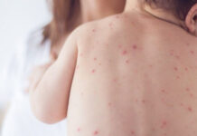 Вітрянку можна попередити: лікарі нагадують про вакцинацію