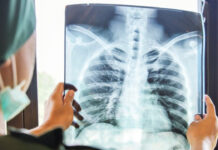 На Вінниччині зафіксували майже 500 випадків туберкульозу з початку року