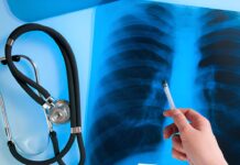 На Вінниччині за рік зафіксували 620 випадків туберкульозу