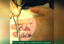 Вінницькі хірурги відновили рухливість пальців 9-річному хлопчику