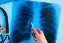 Туберкульоз на Вінниччині: статистика 2025 року та важливість своєчасного виявлення