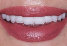 Композитні вініри як спосіб швидкої та делікатної корекції усмішки Композитні вініри для делікатної корекції усмішки